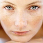 macchie-solari-donna